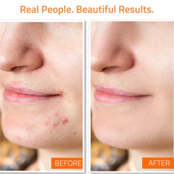 NIB Yeouth Acne Skin System - Picture 3 of 10